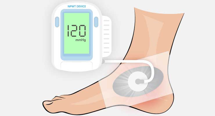The Critical Role of Dressings in Negative Pressure Wound Therapy (NPWT)